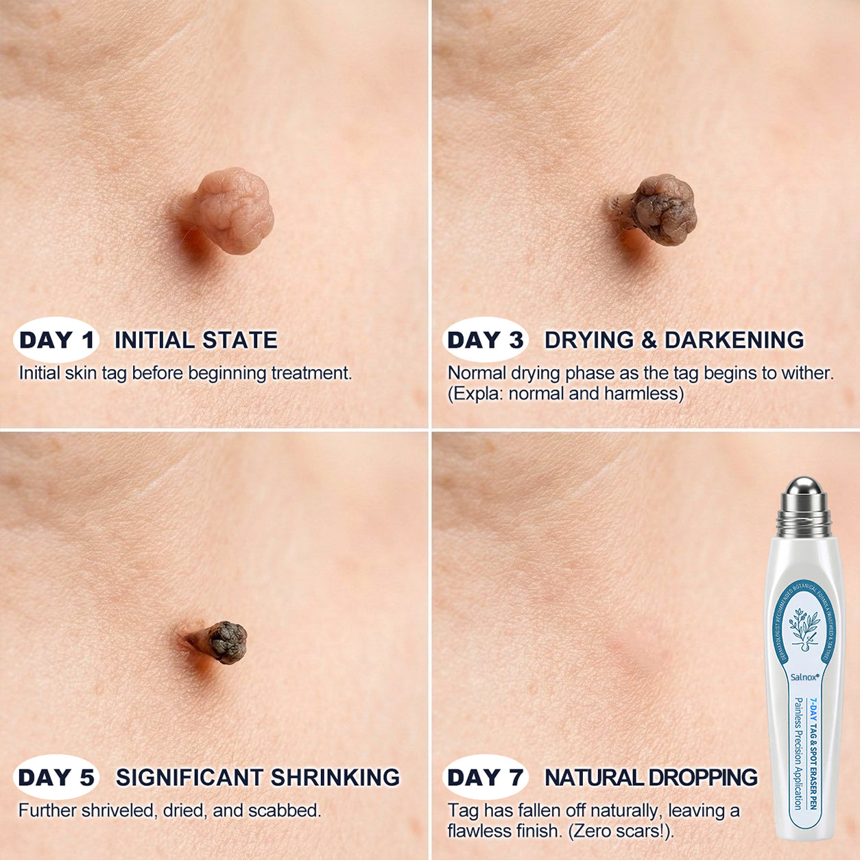 Salnox® 7-𝐷𝑎𝑦 𝗧𝐚𝐠 & 𝗦𝗽𝐨𝐭 𝐄𝐫𝒂𝒔𝒆𝒓✅🎉(Zero Pain, Zero 𝐒𝐜𝐚𝒓𝒔 Rollerball)