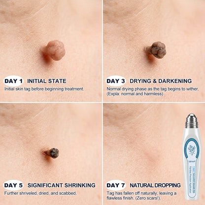 Salnox® 7-𝐷𝑎𝑦 𝗧𝐚𝐠 & 𝗦𝗽𝐨𝐭 𝐄𝐫𝒂𝒔𝒆𝒓✅🎉(Zero Pain, Zero 𝐒𝐜𝐚𝒓𝒔 Rollerball)