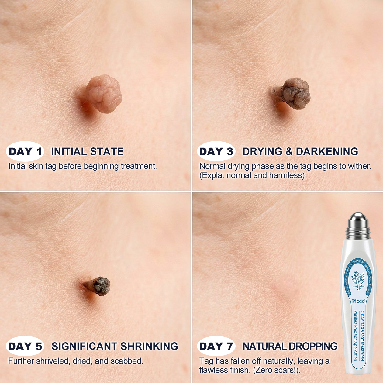 Salnox® 7-𝐷𝑎𝑦 𝗧𝐚𝐠 & 𝗦𝗽𝐨𝐭 𝐄𝐫𝒂𝒔𝒆𝒓✅🎉(Zero Pain, Zero 𝐒𝐜𝐚𝒓𝒔 Rollerball)